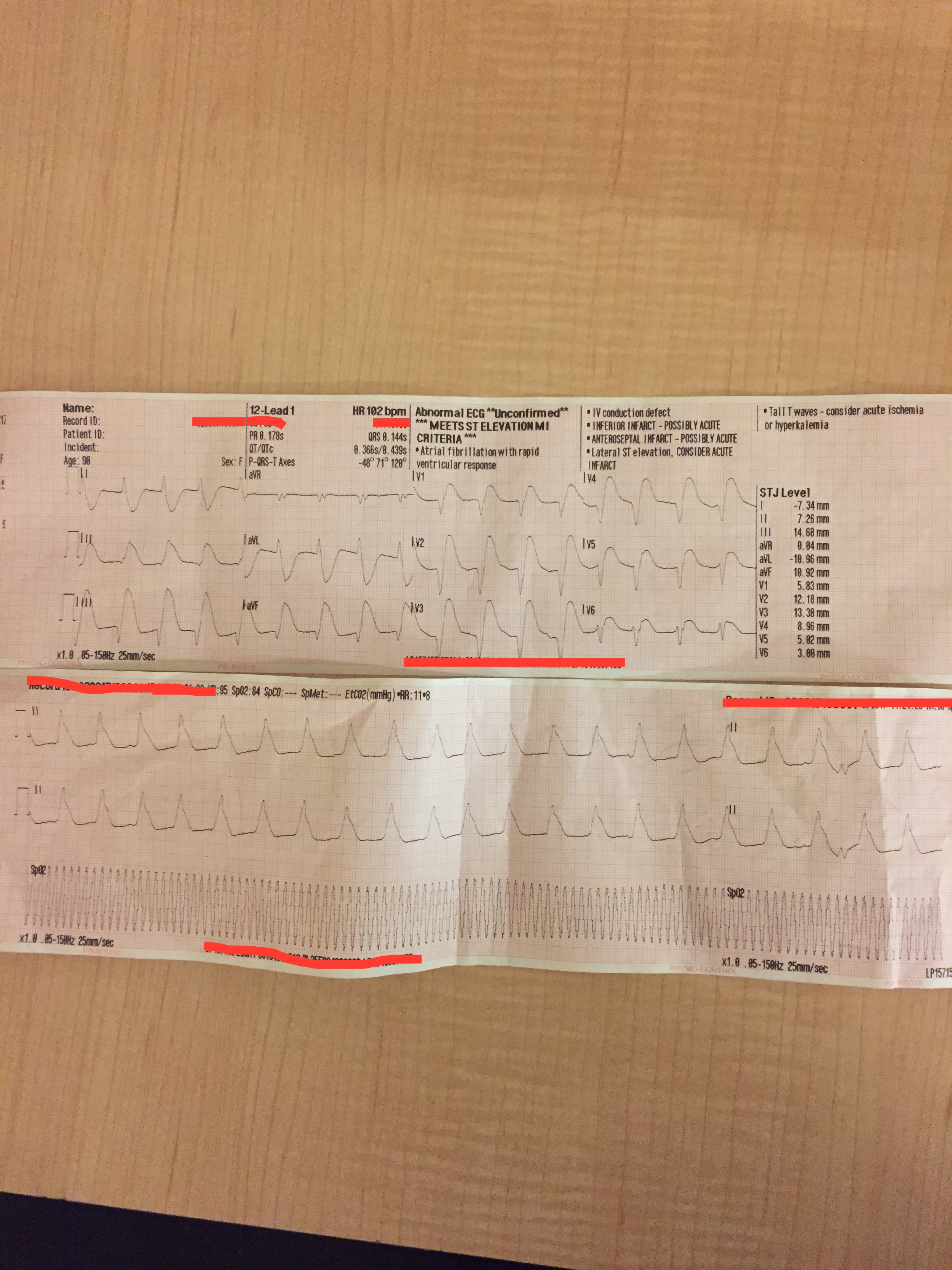 12 lead post arrest.JPG