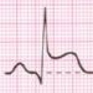 stemi
