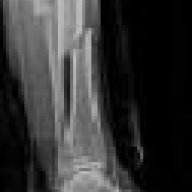 Crepitus