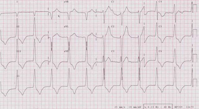 Accelerated20idioventricular20rhyth.jpg