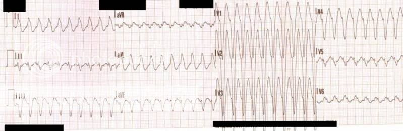 WCT_LBBB.jpg