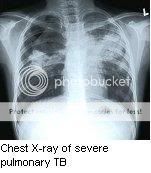 chest20x20ray20of20severe20pulmonar.jpg