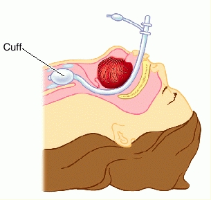 tube_orotracheal.jpg