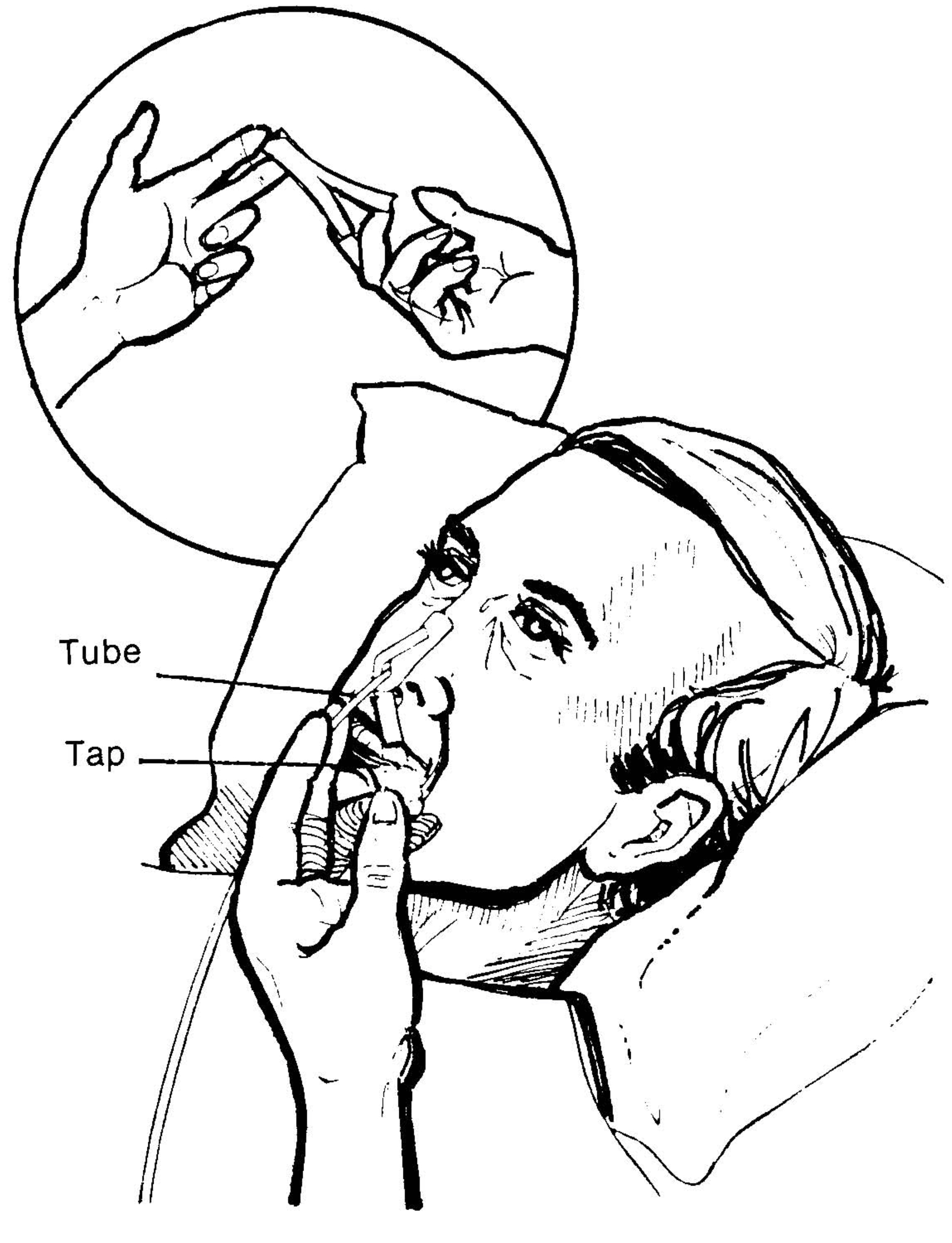 Tape-the-Nasogastric-Tube.jpg