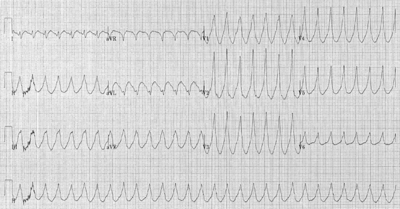 800px-Electrocardiogram_of_Ventricular_Tachycardia.png
